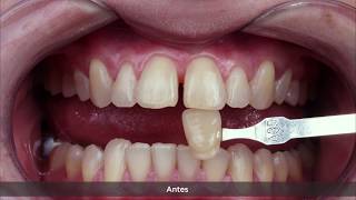 ESP Blanqueamiento y cierre de diastema con Whiteness HP AutoMixx y Vittra APS [upl. by Yesnik]