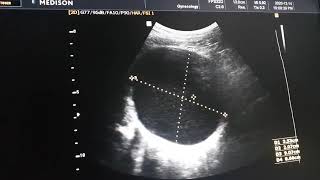 Bilateral Adnexal cystic Masses [upl. by Lleneg]