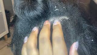 Dandruff Hair Scratching ASMR [upl. by Anert575]