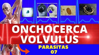 ONCOCERCOSE  ONCHOCERCA VOLVULUS VERMINOSE  PARASITOLOGIA  INFECTOLOGIA [upl. by Pollitt953]