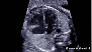 Fetal heart Academy  Enlarged heart 1 four chamber view example 2 [upl. by Forsta600]