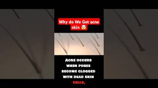 Why do We Get acne skin 🤯 acne acnetreatment acnecauses trendingshorts viral facts foryou fy [upl. by Mimajneb]