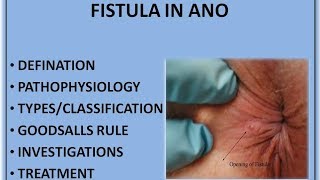 FISTULA IN ANO HINDI [upl. by Geof]