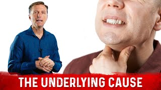 Burning Throat Syndrome or Silent Acid Reflux Causes – DrBerg [upl. by Samot802]