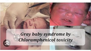 Gray baby syndrome by chloramphenicol toxicity pharmacology contraindications infants [upl. by Aromat]