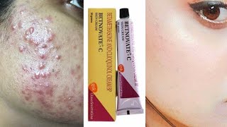 Betnovate C Cream Uses amp Side Effects  Betnovate C Cream HONEST Review 2022 In Hindi [upl. by Raskind790]