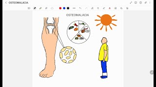 OSTEOMALACIA [upl. by Morna477]