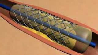 Stent Animation [upl. by Marquardt]