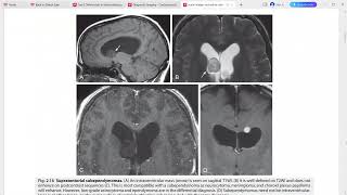 CORE REQUISITES of neuroradiology [upl. by Neerak559]