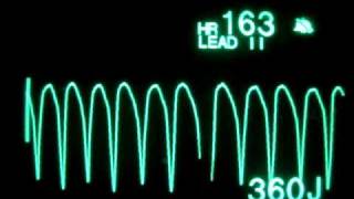 Pulseless Ventricular Tachycardia pVT  Monophasic Defibrillation at 360 Joules [upl. by Dorice]