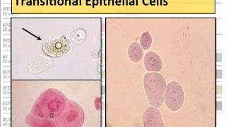 Microscopic Urine Sediment  Part 2  Epithelial Cells [upl. by Aelsel993]