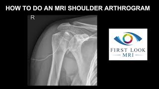 How to do an MRI shoulder arthrogram [upl. by Pahl]