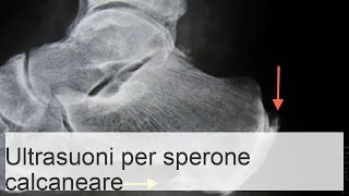 Recensioni sullefficacia della terapia ad onde durto per speroni calcaneali [upl. by Hassett]