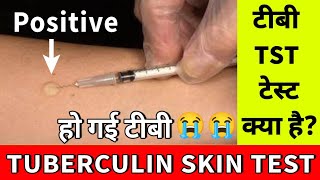 टीबी का Skin Test क्या है  Tuberculin Skin Test   TB Skin Test  TST से टीबी की जांच [upl. by Donnelly700]