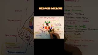 webersyndrome clinicalneuroanatomy midbrain [upl. by Lednar678]