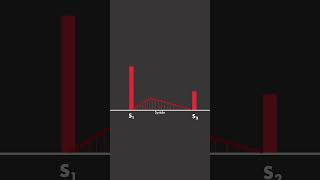 Aortic Stenosis [upl. by Allanson]