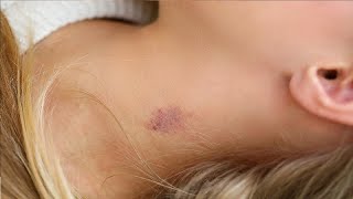 easiest way to give a hickey in 3 minutes [upl. by Annawad]