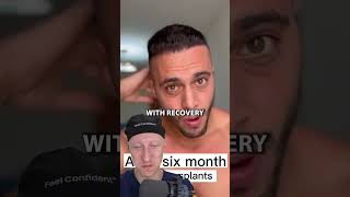 Six Month Hair Transplant Result  Plastic Surgeon Reacts [upl. by Mccall]