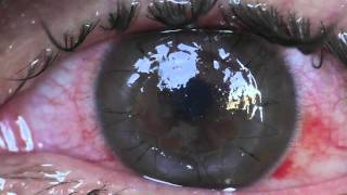 OffTopic Stitches of corneal graft  transplant  Incredible [upl. by Lokcin219]