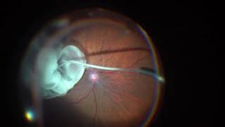 vitrectomy for macular pucker Epiretinal Membrane [upl. by Enoed]