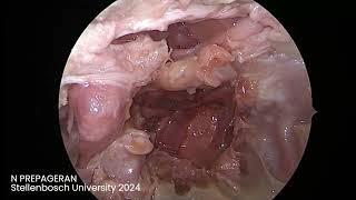 Module 10 Endoscopic Transclival approach and review of anatomy [upl. by Ut]