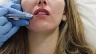 Juvederm lip filler injection by Dr Shaun Patel in Miami Florida [upl. by Aiotal340]