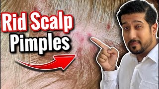 Scalp Pimples Removal  5 Fast and Easy Ways to Get Rid of Scalp Pimples [upl. by Dnalel]