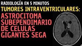 Radiología en 5 minutos Tumores intraventriculares Astrocitoma Subependimario de Celulas Gigantes [upl. by Ignazio]