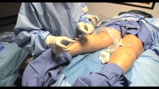 Radio frequency Ablation of Varicose Vein how does it works [upl. by Aitnwahs]