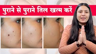 चेहरे के तिल बिना लेज़र या सर्जरी के कैसे ख़त्म करें  Remedies For Mole Removal  Upasana Ki Duniya [upl. by Chaing]