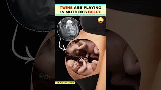 Twins movement in the womb  Fetal movement  Baby Kicks shortsvideo pregnancy love [upl. by Eldoree43]