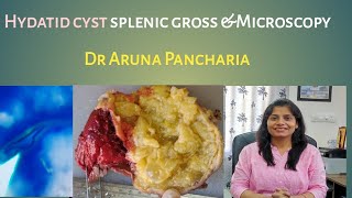 Spleen hydatid cystGross microscopy pathology mbbs histopathology [upl. by Dhruv]