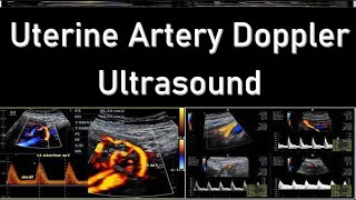 Uterine Artery Doppler Ultrasound Interpretation  Doppler Ultrasound in Fetal Growth Assessment [upl. by Gerianne]