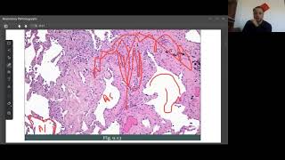 Restrictive lung disease by Doc Fazals Online Class video in UrduHindi Pathoma [upl. by Blatt]