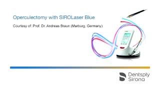 Operculectomy with SIROLaser Blue highres [upl. by Woody]