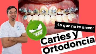 ¡ORTODONCIA Y CARIES LA ORTODONCIA PUEDE DESTRUIR TUS DIENTES CEPILLARSE LOS DIENTES CON BRACKETS [upl. by Roman]