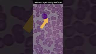 Así se ve la sangre infectada con DENGUE analisisclinicos dengue virusdeldengue [upl. by Adelric]