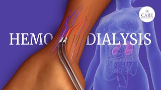 What is Hemodialysis  How is Hemodialysis Done [upl. by Eneleh]