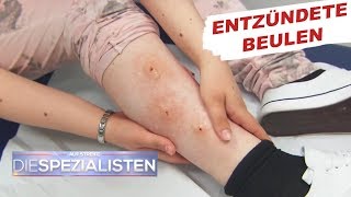 Beulen an den Beinen Parasitenbefall  Auf Streife  Die Spezialisten  SAT1 TV [upl. by Aisatsanna561]