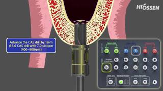 Hiossen Osstem Caskit Crestal approach sinus lift Sinus pohjan nosto [upl. by Eineg]