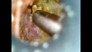 Ear wax removal on exostoses swimmers ear [upl. by Elin178]