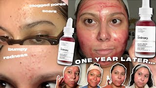 the ordinary peeling solution ONE YEAR results and review [upl. by Tannenbaum]