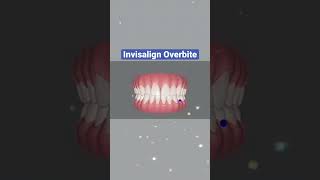 Invisalign Overbite [upl. by Assiled]