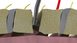 Removing osteophytes during ACDF using Dreal® technology [upl. by Iverson886]