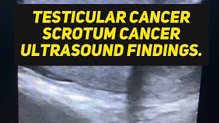 Testicular cancer ultrasound suspected case [upl. by Griz365]