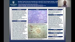 Medullary Thyroid Carcinoma Associated with a Rare RET ProtoOncogene Mutation pK666N [upl. by Loydie44]