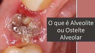 O que é Alveolite ou Osteíte Alveolar  Odontologia  Dra Bianca Rosa [upl. by Luahs]