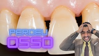 PERDA ÓSSEA NA BOCA E AO REDOR DOS DENTES [upl. by Eillil144]