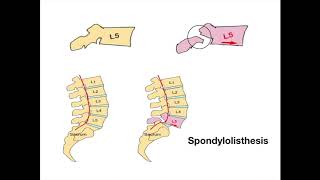 Spondylolisthesis [upl. by Tasiana698]