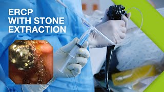 ERCP Practical Guide I Part 2 ERCP with Stone Extraction [upl. by Nitnert]